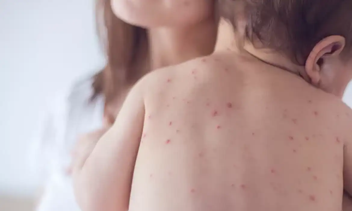 Manchas vermelhas no corpo e febre: aprenda a identificar os sinais do sarampo