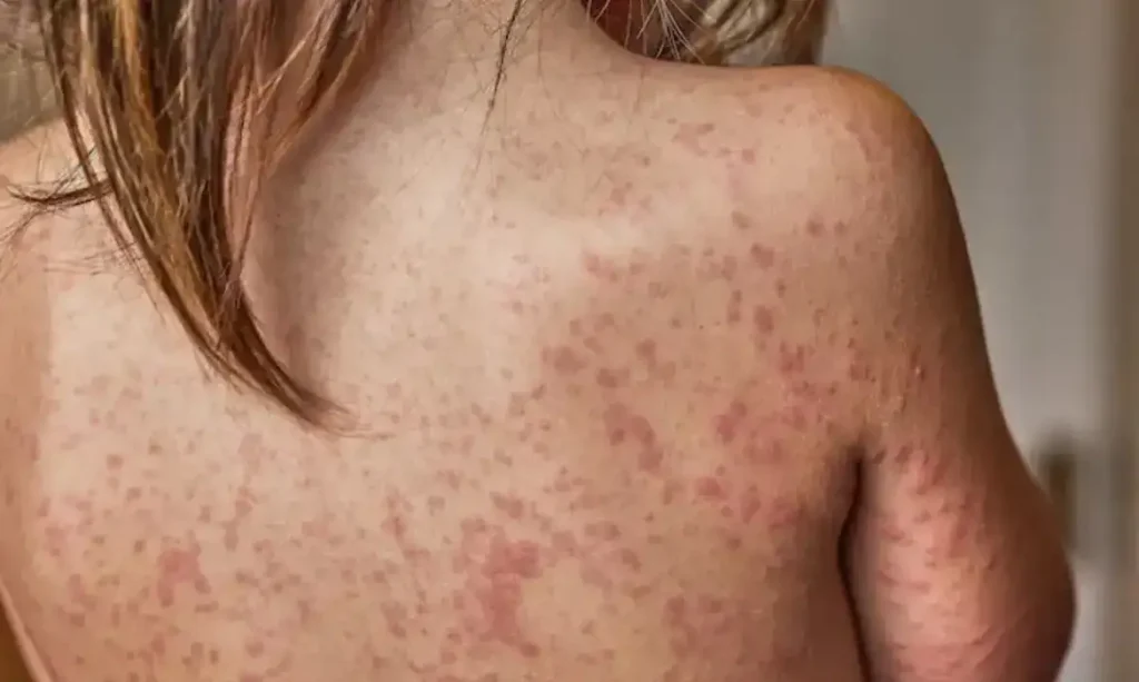 Sarampo avança nas Américas e Saúde aciona alerta de risco no Brasil